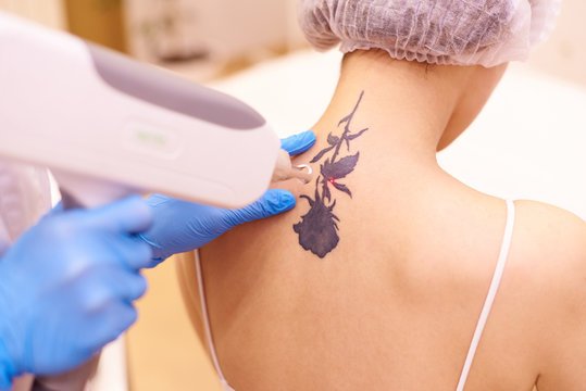 Tattoo Removal​