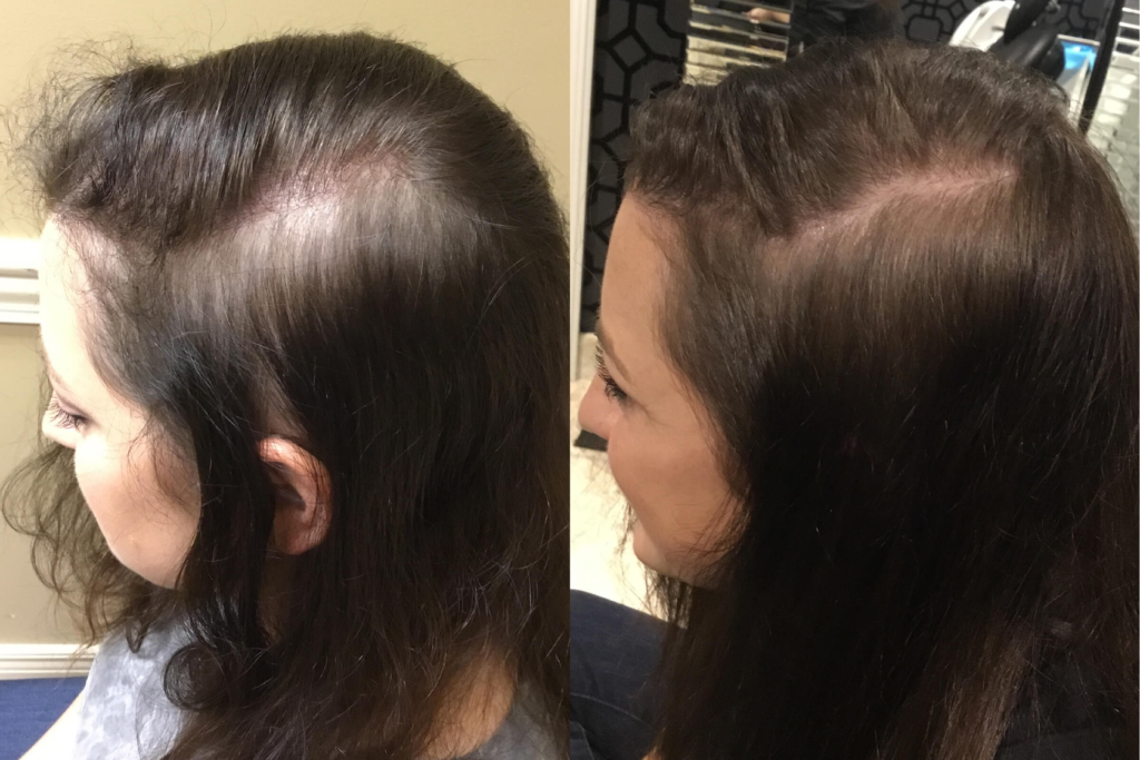 Hair Fall Treatment