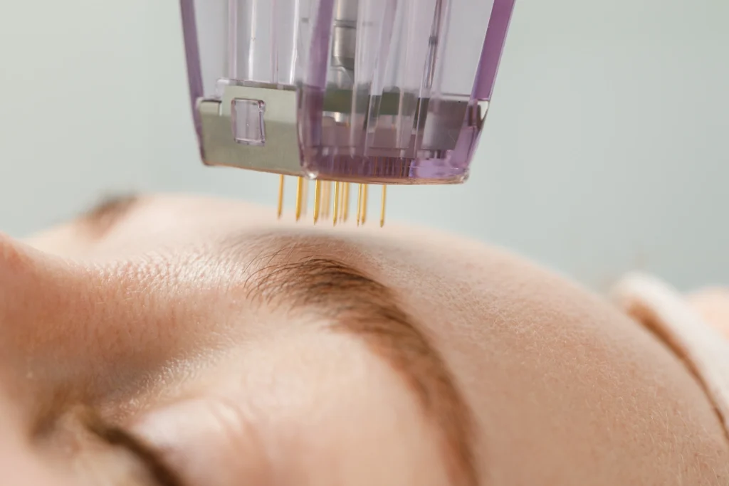 RF Microneedling​