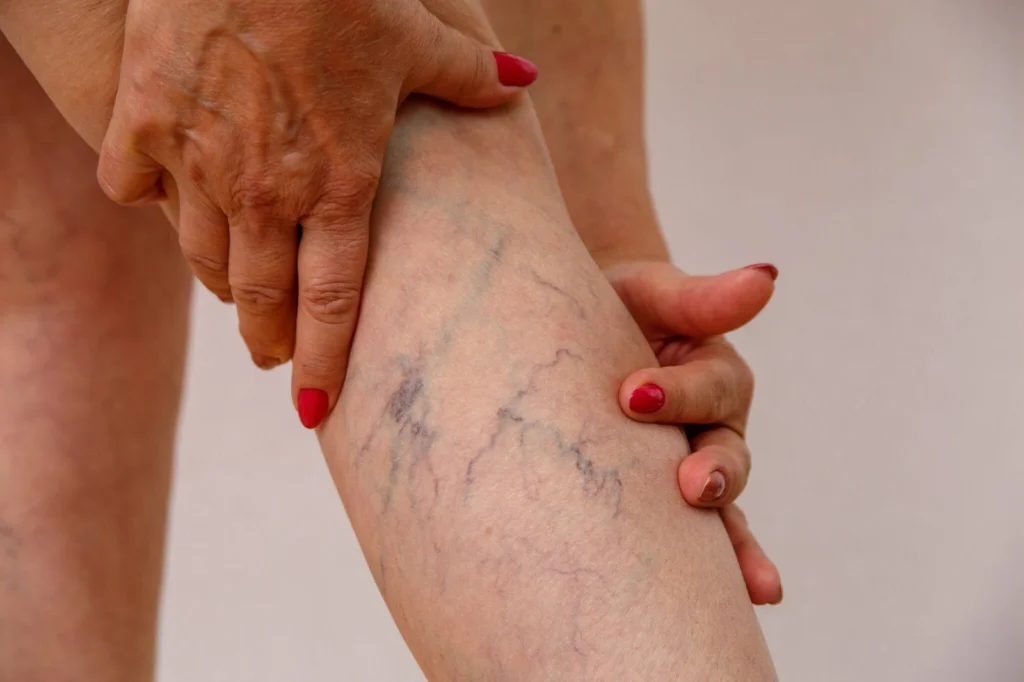 Spider Vein Treatment