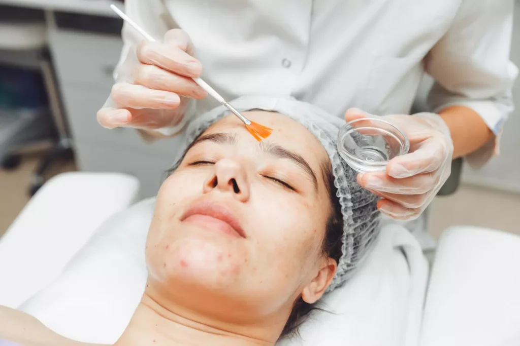 Skin pigmentation treatment by chemical peel to reduce dark spots and uneven skin tone.