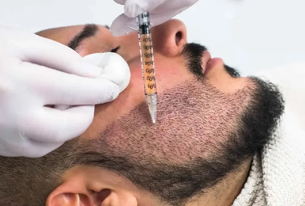 Beard hair transplant in Dubai before and after results