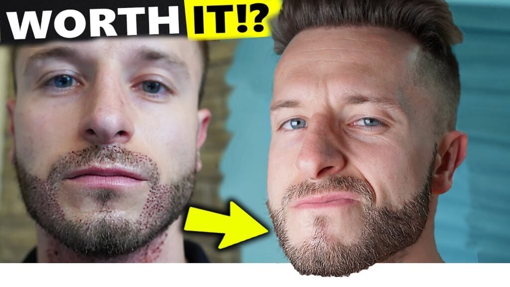 Beard Transplant Before and After – Setting Realistic Expectations