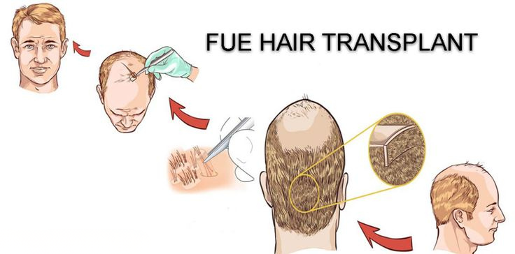 FUE Hair Transplant