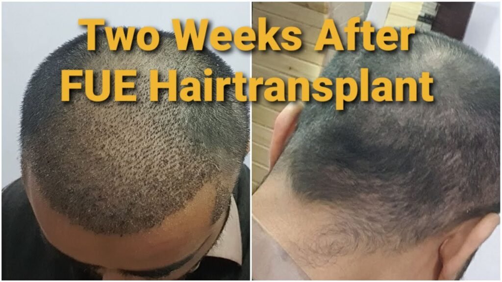 Recovery Process After Hair Transplant