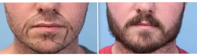 Beard Hair Transplant Dubai
