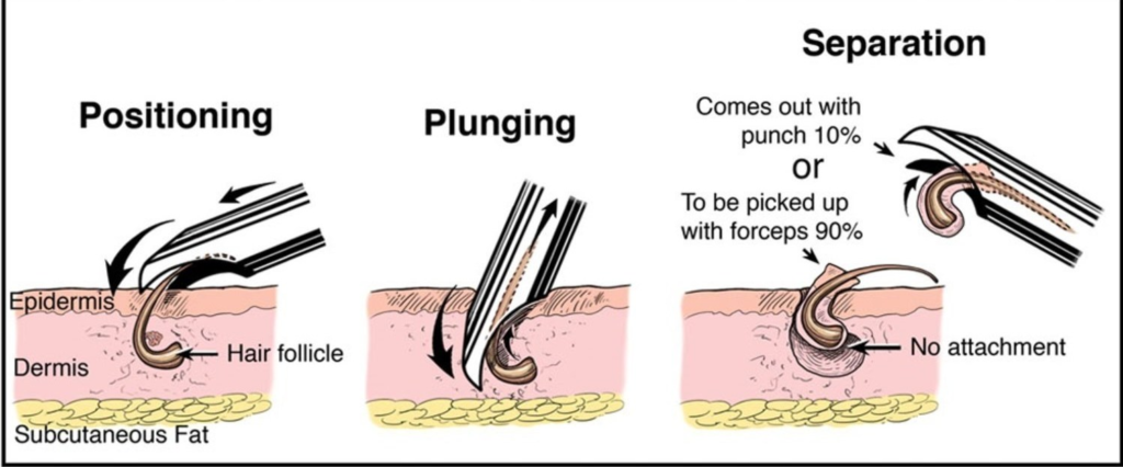 Follicle Extraction