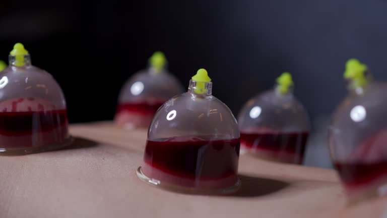 Wet Hijama Therapy