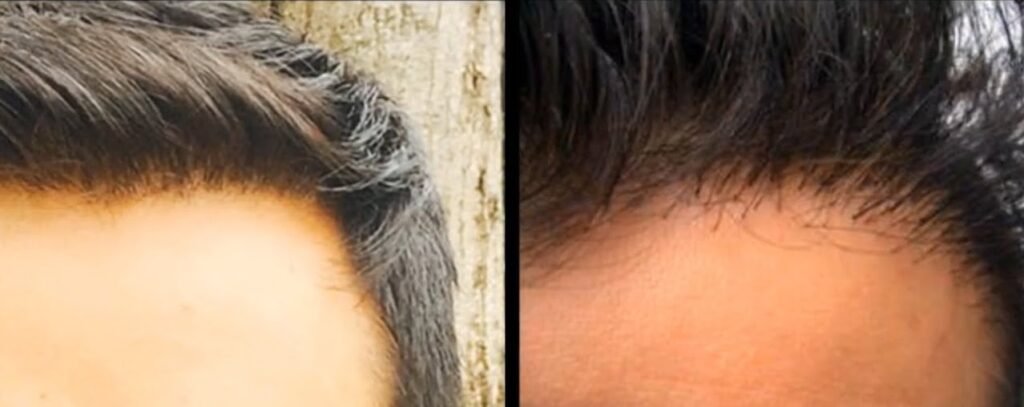 Dhi vs fue hair transplant