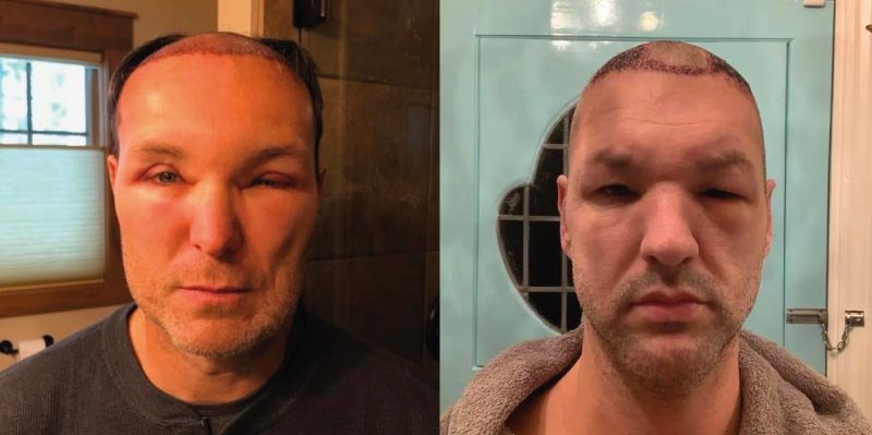 Hair Transplant Side Effects